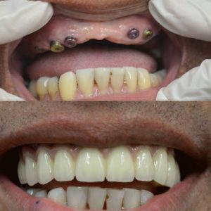 implant dentar-cum arata